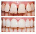 Cheap Veneers and Dentures, Cosmetic Dentistry in Westmeath &Denture Repairs in image 5