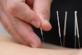 Slievemore Medical Acupuncture Clinic image 4
