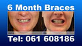 Braces in 6 Months logo