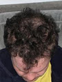 Vinci Hair Clinic - Hair Transplants - Ireland image 4