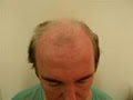 Vinci Hair Clinic - Hair Transplants - Ireland image 5