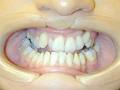 acebraces-o regan orthodontics image 3