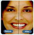 Laser Teeth Whitening image 2